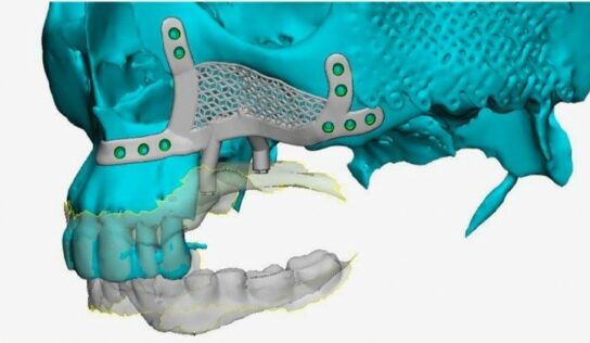 El Dr. Montesdeoca reconstruye el hueso maxilar superior gracias a unos implantes dentales subperiósticos