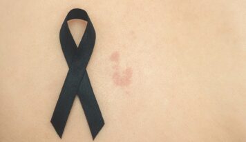 «Exponerse al sol sin protección puede tener consecuencias graves tanto a corto como a largo plazo», explica la dermatóloga Maribel Martínez