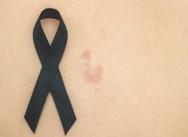 «Exponerse al sol sin protección puede tener consecuencias graves tanto a corto como a largo plazo», explica la dermatóloga Maribel Martínez