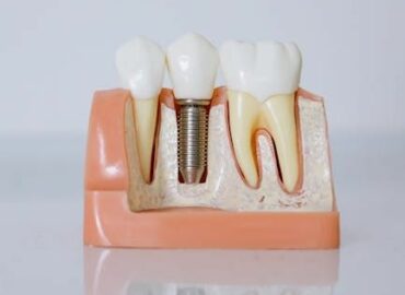 Dr. Javier Ortiz de Urbina: «El éxito de un implante dental depende en gran medida de la experiencia del profesional»