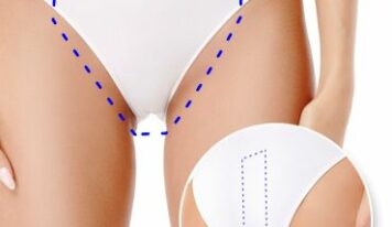 Tecnología YAG Candela facilita depilacion bikini brasileño en Kopay de Gele Giner