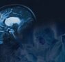 GEN y Sulfateq anuncian resultados positivos en fase 1 del fármaco SUL-238 para el Alzheimer