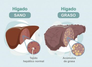 Dr. Juan Arenas, jefe servicio Aparato Digestivo:»Hoy disponemos de un nuevo medio no invasivo para detectar la fibrosis hepática»