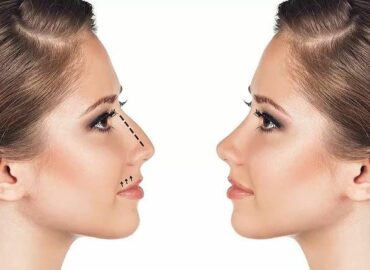 La rinoplastia ultrasónica gana terreno en México, explica el Dr. José Cortés
